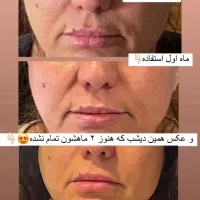 سرم لیفتینگ گاتیو|آرایشی، بهداشتی، درمانی|شیراز, طلاب|دیوار
