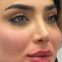 تزریق فیلر و بوتاکس با مواد درجه یک