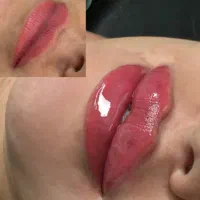 مدل رایگان برای ژل و بوتاکس لب زاویه فک و...