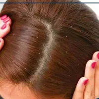 درمان بدون درد سر شوره مو|آرایشی، بهداشتی، درمانی|شادگان, |دیوار