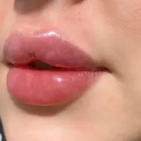تخفیفات ژل و بوتاکس در مطب پزشک|خدمات آرایشگری و زیبایی|سنندج, |دیوار
