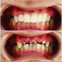 روکش سرامیکی - روکش pfz