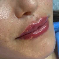 ژل و بوتاکس پاییزی