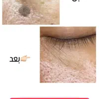 پاک سازی خال گوشتی و زگیل تو ۳ روز