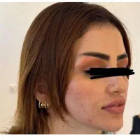 تزریق وآموزش ژل و بوتاکس چربی توسط دانشجویی پزشکی|خدمات آرایشگری و زیبایی|اهواز, زیتون کارمندی|دیوار