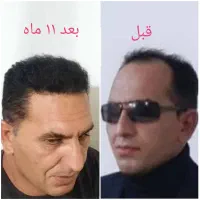 کاشت مو تضمینی واقساط|خدمات آرایشگری و زیبایی|اصفهان, محمودیه|دیوار