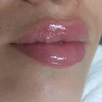 تزریق تخصصی فیلر و بوتاکس و مزو و... در مطب
