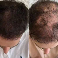 راهکاری قطعی برای پررپشتی موهای شما