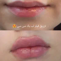 تتو و ژل و بوتاکس و خال برداری