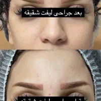 جراحی زیبایی بلفاروپلاستی،مینی لیفت صورت|خدمات آرایشگری و زیبایی|اندیشه, اندیشه فاز ۱|دیوار