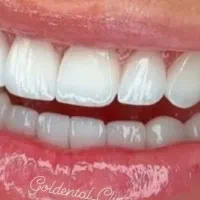 کامپوزیت دندان روکش دندانپزشک تهرانسر اکباتان خلیج|خدمات آرایشگری و زیبایی|تهران, تهرانسر شمالی|دیوار