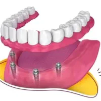 بلیجینگ' لمینت' کامپوزیت عصب کشی/بهترین مارک‌ها