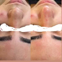 فیشال پوست+آموزش فیشال مدرس فنیوحرفهای|خدمات زیبایی و سلامت|رشت, بلوار گیلان|دیوار