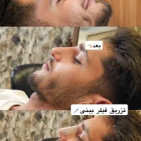 خدمات رایگان بوتاکس،ژل،فیلر توسط پزشک در ارومیه