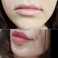 انجام تمامی خدمات فیلر و بوتاکس