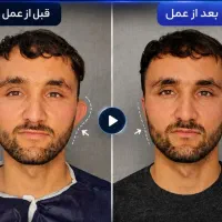 جشنواره ویژه جراحی زیبایی گوش/عمل گوش/اتوپلاستی