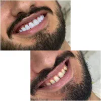 لمینیت دندان