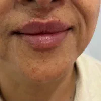 نیازمند مدل خانم جهت تزریق فیلر لب