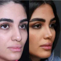 جشنواره جراحی بینی، لیپو، شکم، اسلیو ،اقساطی