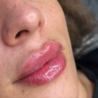 تخفیف های باور نکردنی ژل و بوتاکس و جوانساز ها