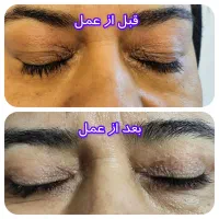 عمل زیبائی پلک و عمل رفع پف زیر چشم