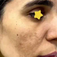 آموزش فیشیال تخصصی. مزو جوانساز صورت|خدمات آموزشی|کوهدشت, |دیوار