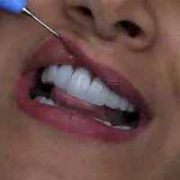 زیبایی و‌سلامت دندان لمینیت و کامپوزیت