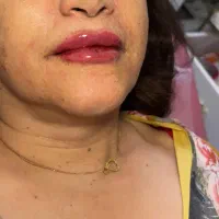 مطب تزریق فیلر(ژل)لب بادی کانتور چانه لیفت بوتاکس|خدمات زیبایی و سلامت|تهران, امامت|دیوار