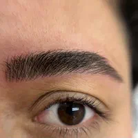 میکروبلیدینگ و میکروپیگمنتیشن/فیبروز،شیدلب،خط چشم