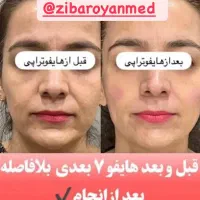 جوانسازی و لیفت بدون جراحی