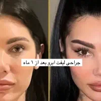 جراحی لیفت ابرو،دایرکت ابرو،لیفت شقیق ،پیشانی|خدمات آرایشگری و زیبایی|تهران, پاسداران|دیوار