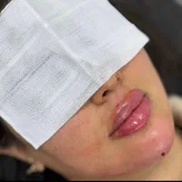 تزریق ژل وبوتاکس هایفو|خدمات آرایشگری و زیبایی|مشهد, کوی سیدی|دیوار