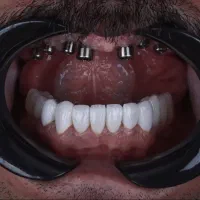 ایمپلنت حرفه ای در پردیس بهترین فرصت برای انجام