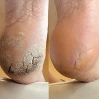 پدیکور روسی ،درمان ترک پا