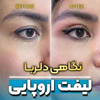 جشنواره لیفت اروپایی چشم پلک ابرو بینی بدون بیهوشی|خدمات آرایشگری و زیبایی|مشهد, هفت تیر (حافظ)|دیوار