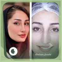 عمل بینی/ جراحی بینی|خدمات آرایشگری و زیبایی|شیراز, تاچارا|دیوار