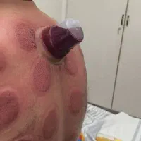 حجامت. فصد. زالودرمانی. بادکش.