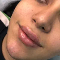 مدل ژل و بوتاکس|خدمات آرایشگری و زیبایی|اصفهان, شهرک کاوه|دیوار