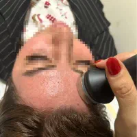 دستگاه قوی RF صورت