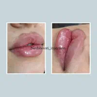 تخفیف ژل/بوتاکس/مزو/آنزیم/ساکشن غب غب|خدمات آرایشگری و زیبایی|اهواز, کیانپارس |دیوار