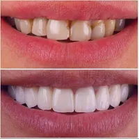 بمب تخفیفات دندانپزشکی با کیفیت بینظیر بمدت 3روز