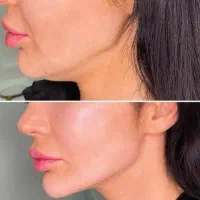 آف ویژه بالن وبوتاکس معده،ژل و بوتاکس وبفاروپلاستی|خدمات آرایشگری و زیبایی|اهواز, کیانپارس |دیوار