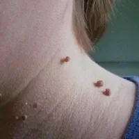 زگیل یا خال گوشتی لیزر در منزل