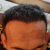 کاشت مو با اقامت رایگان