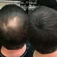دیگه کاشت مو نکن