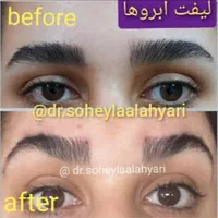 غبغب بوکال لیفت شقیقه سانترال چربی ژل بوتاکس|خدمات آرایشگری و زیبایی|شیراز, قدوسی غربی|دیوار
