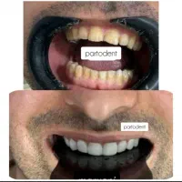 کامپوزیت در منزل. ایذه، باغملک، هفتکل|خدمات آرایشگری و زیبایی|ایذه, |دیوار