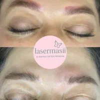 لیزر تتو لک و کربن