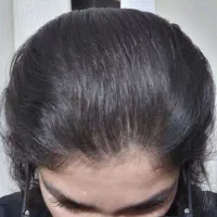 رویش مو