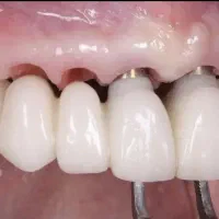 جشنواره تخفیف ایمپلنت در تبریز